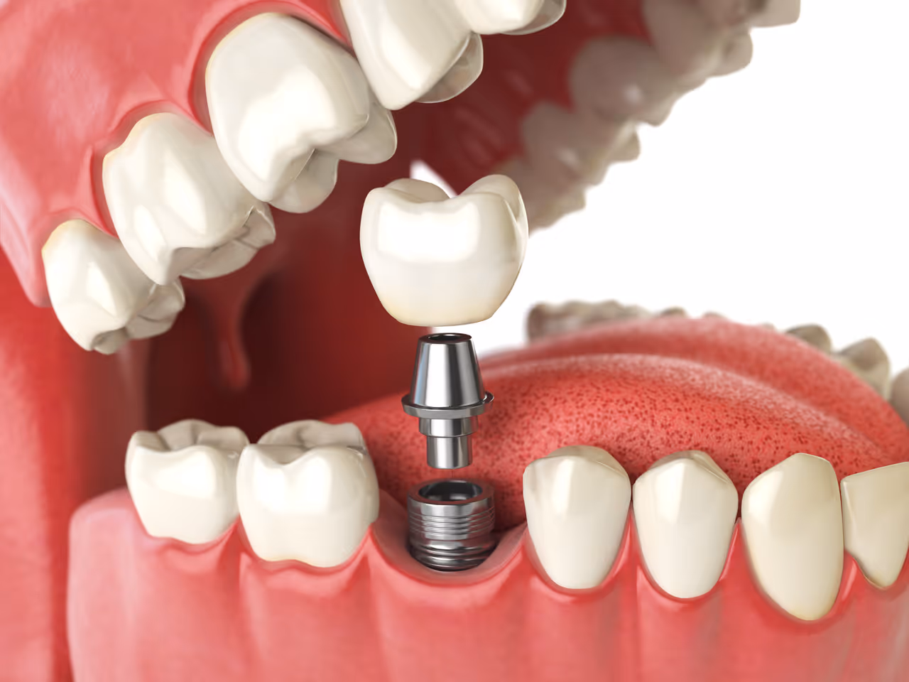 How Dental Crowns Improve Chewing Comfort and Bite Alignment
