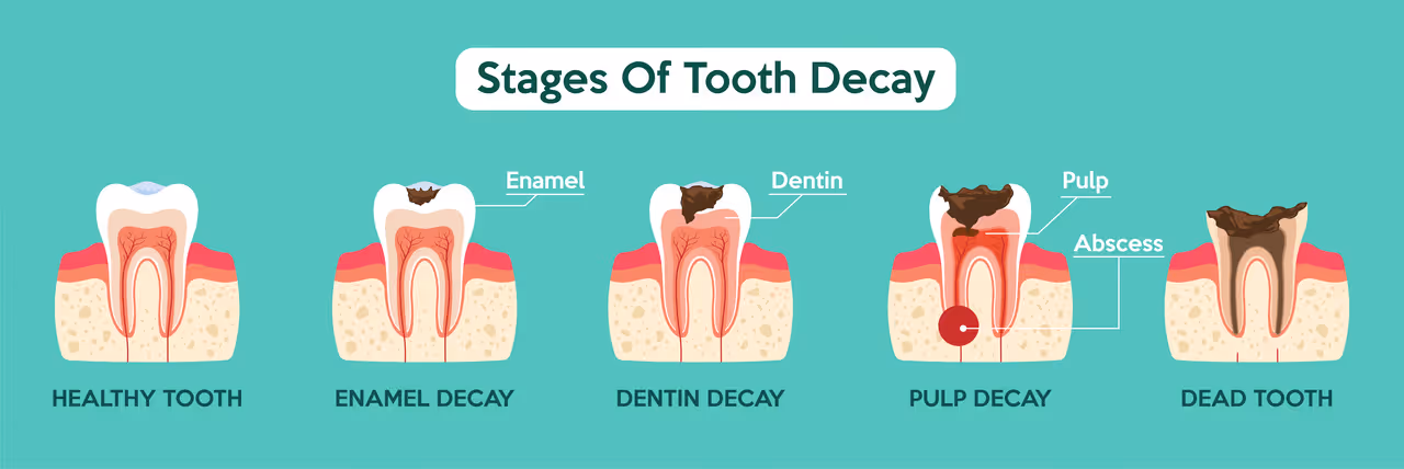 What’s the Best Way to Treat Moderate Tooth Decay?